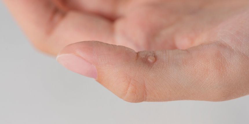 Warts - harmless but annoying